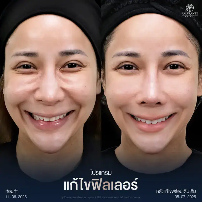 รีวิวแก้ไขฟิลเลอร์เป็นก้อนที่ปาก ที่ Amarante Clinic