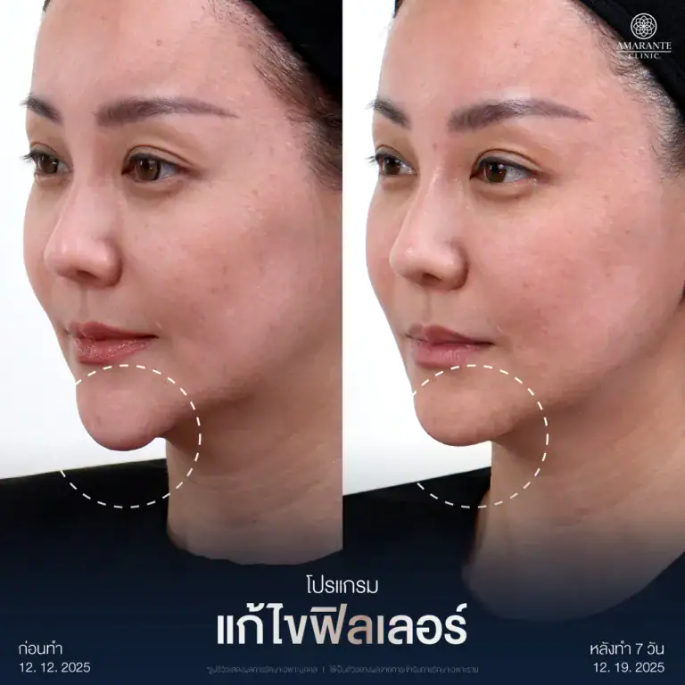 รีวิวแก้ไขฟิลเลอร์เป็นก้อนที่คาง ที่ Amarante Clinic