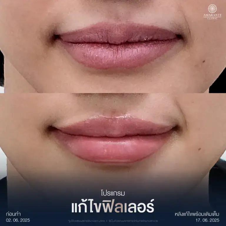 รีวิวแก้ไขฟิลเลอร์เป็นก้อนบริเวณร่องแก้ม ที่ Amarante Clinic