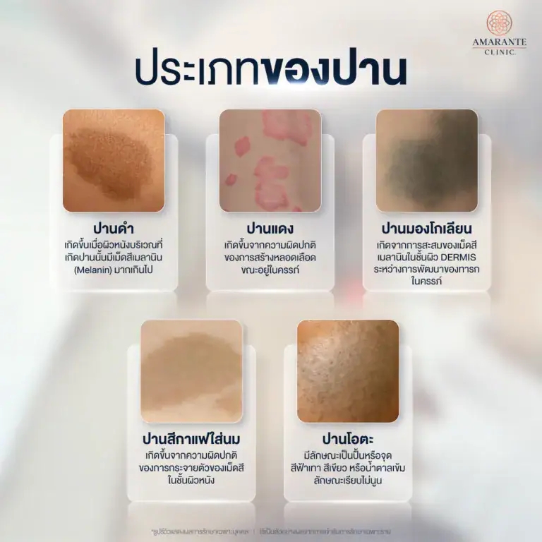 ประเภทของปาน