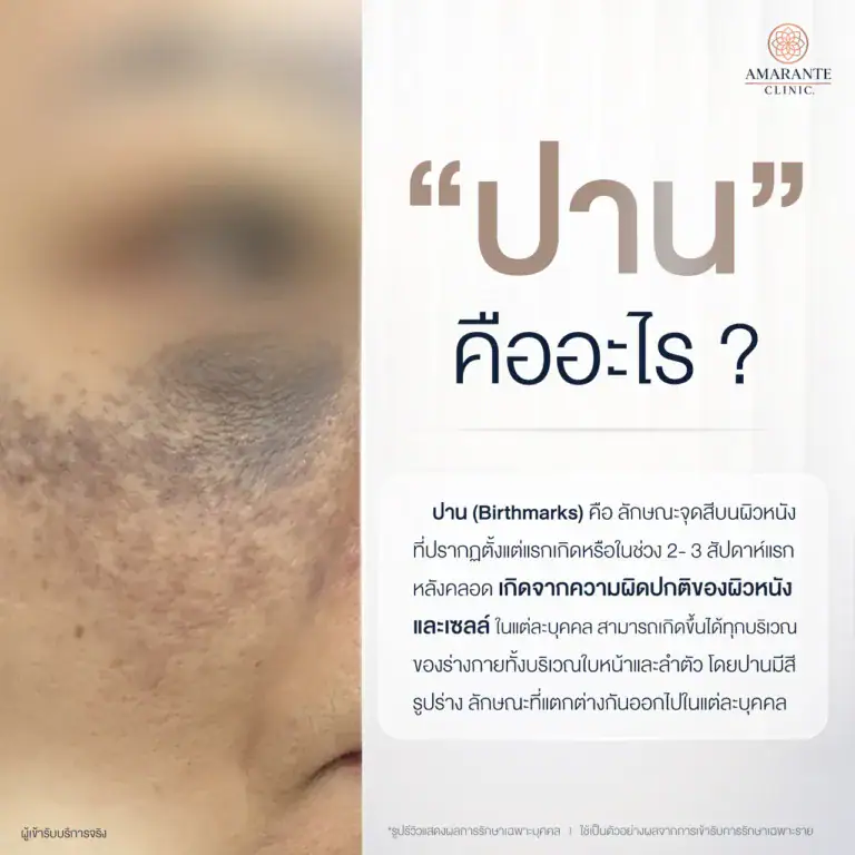ปาน คืออะไร