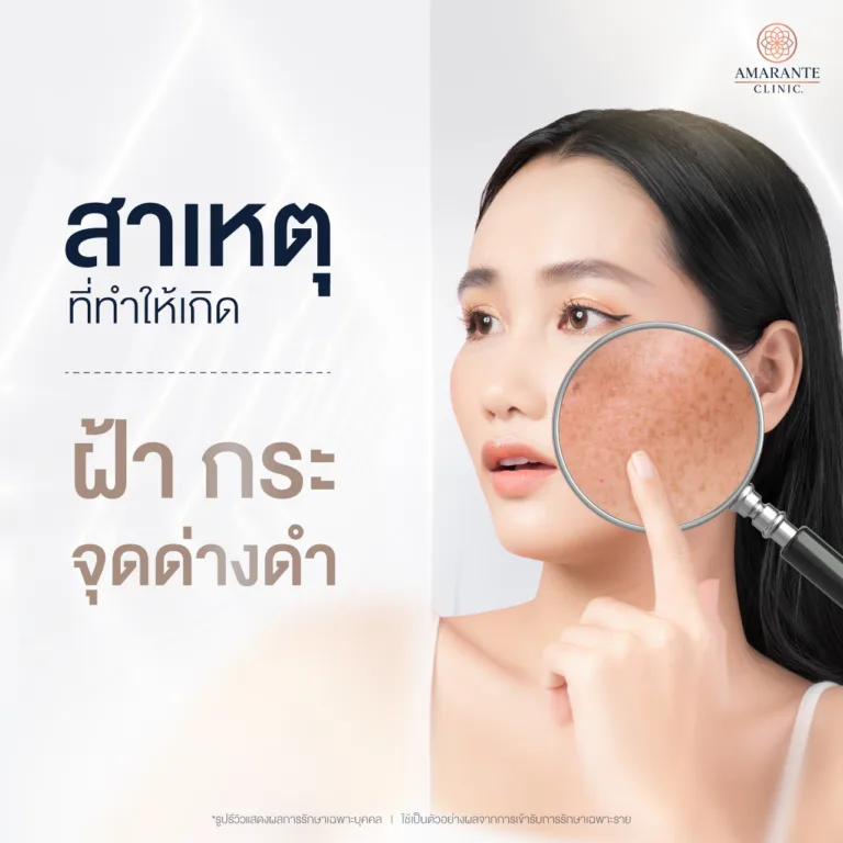 สาเหตุที่ทำให้เกิด ฝ้ากระจุดด่างดำ