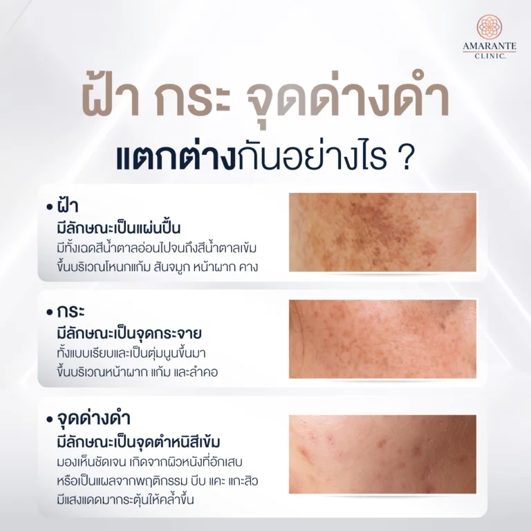 ฝ้า กระจุด ด่างดำ มีความแตกต่างกันอย่างไร