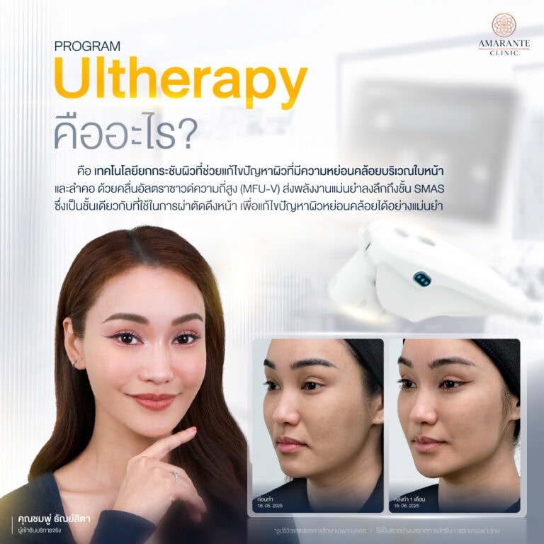 ยกระชับผิวหน้าด้วยโปรแกรม Ulthera