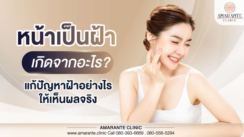หน้าเป็นฝ้าเกิดจากอะไร แก้ปัญหาฝ้าอย่างไรให้เห็นผลจริง