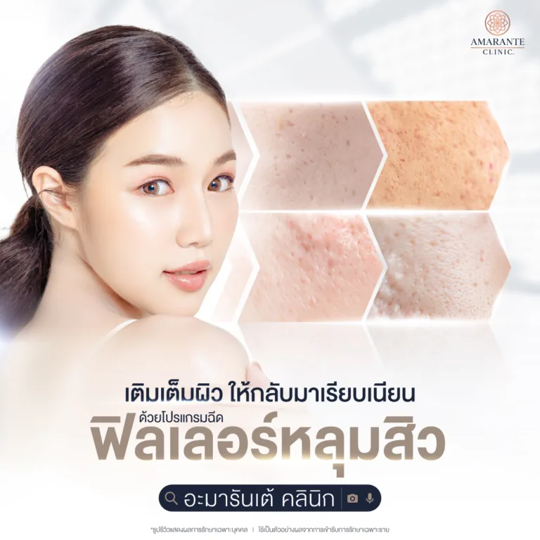 ฉีดฟิลเลอร์ amarate