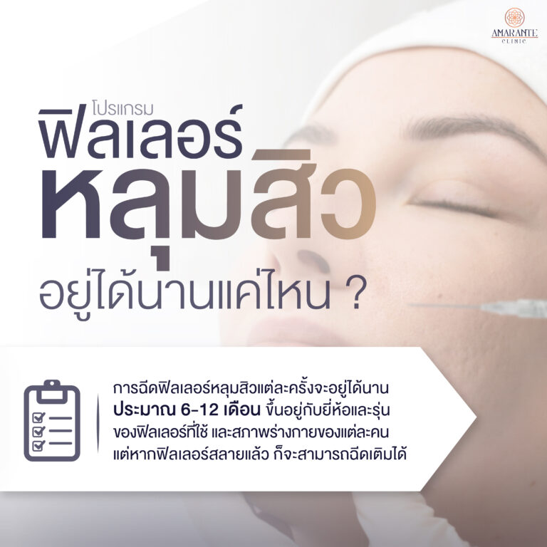 ภาพ infographic ตอบคำถามฉีดฟิลเลอร์หลุมสิวอยู่ได้นานแค่ไหน