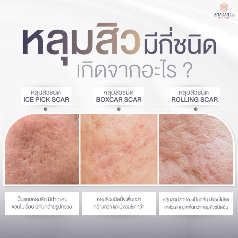 หลุมสิวมีกี่ชนิด เกิดจากอะไร?