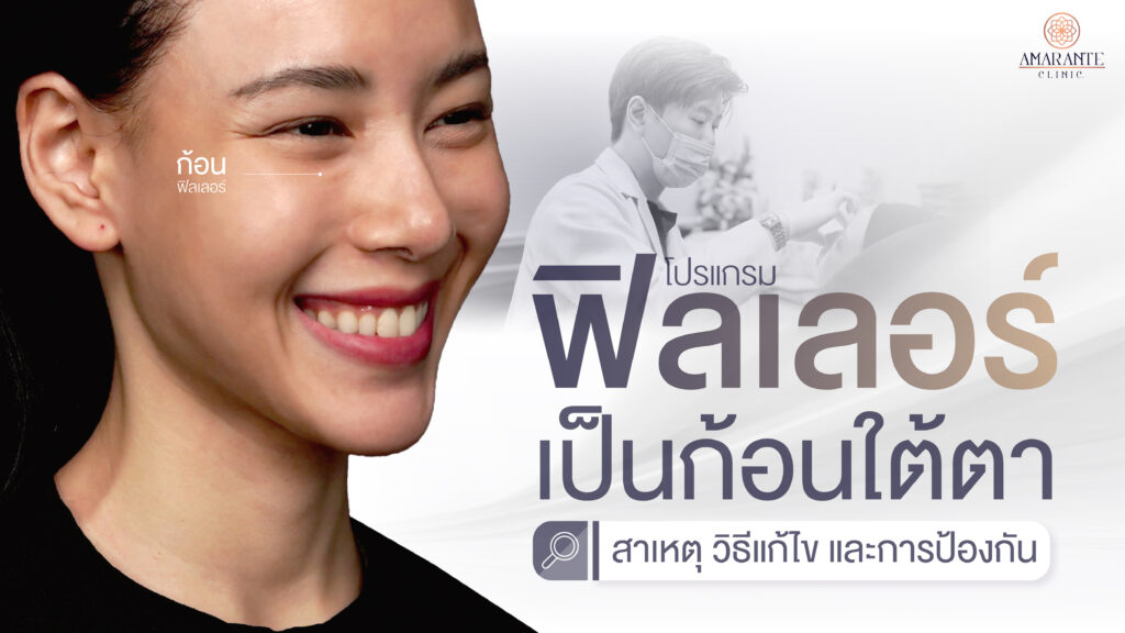ปกภาพของบทความ ฟิลเลอร์เป็นก้อนใต้ตา สาเหตุ วิธีแก้ไข และการป้องกัน