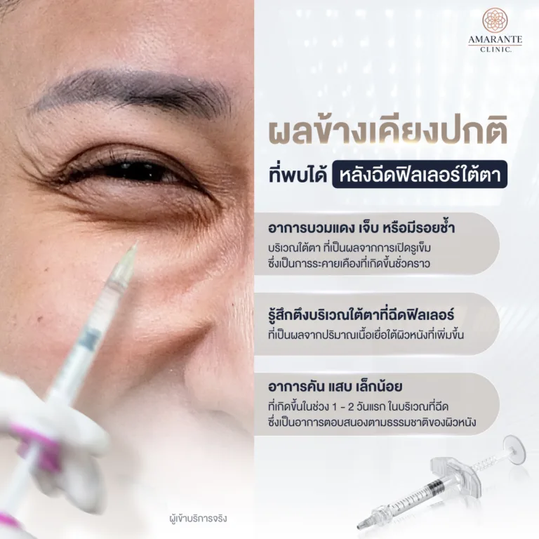 ผลข้างเคียงปกติหลังฉีดฟิลเลอร์ใต้ตา