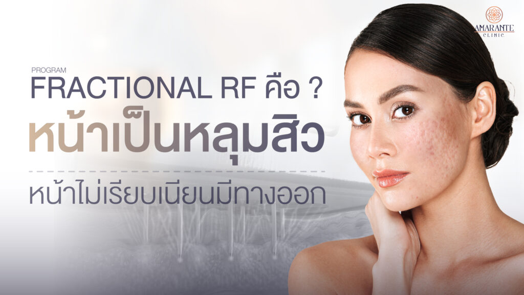 ปกภาพบทความ Fractional RF คือ? หน้าเป็นหลุมสิว หน้าไม่เรียบเนียนมีทางออก