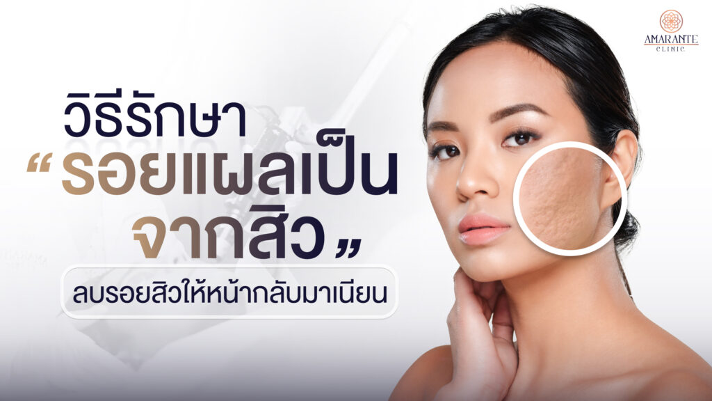 ปกภาพบทความ วิธีรักษารอยแผลเป็นจากสิว ลบรอยสิวให้หน้ากลับมาเรียบเนียน