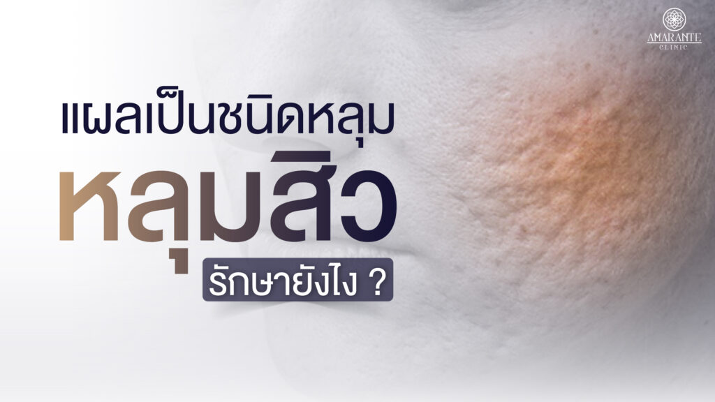 ปกภาพบทความ แผลเป็นชนิดหลุม หลุมลึก รักษายังไง