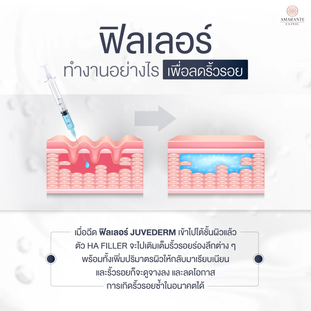 ภาพ infographic อธิบายฟิลเลอร์ Juvederm ทำงานอย่างไร?