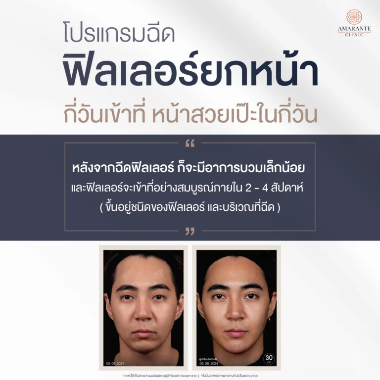 ภาพ infographic ให้คำตอบ ฟิลเลอร์ยกหน้า กี่วันเข้าที่?
