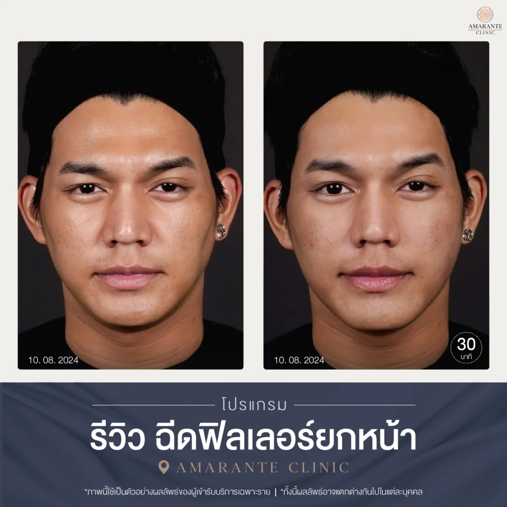 ภาพเคสรีวิวฉีดยกหน้าที่ Amarante Clinic (เคส 3)