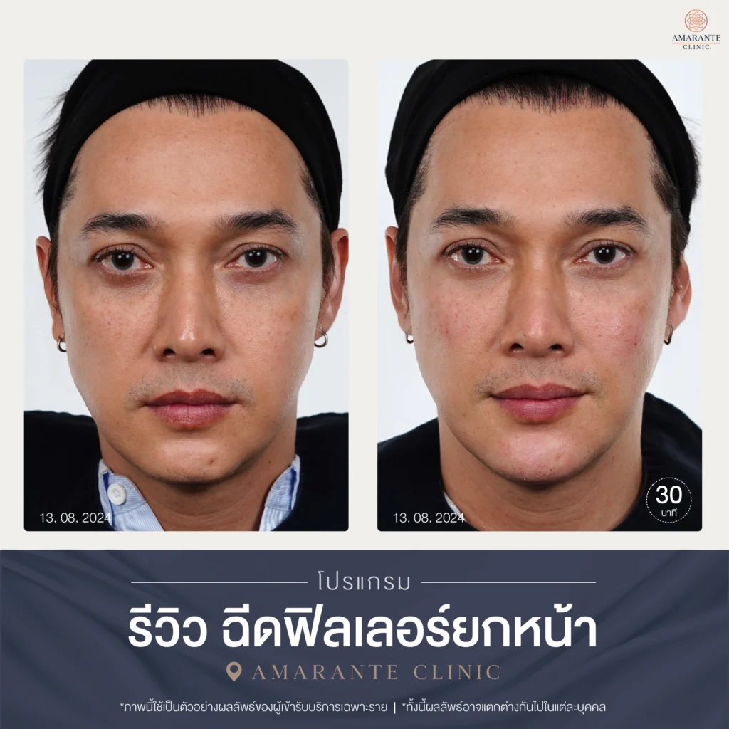ภาพเคสรีวิวฉีดยกหน้าที่ Amarante Clinic (เคส 5)