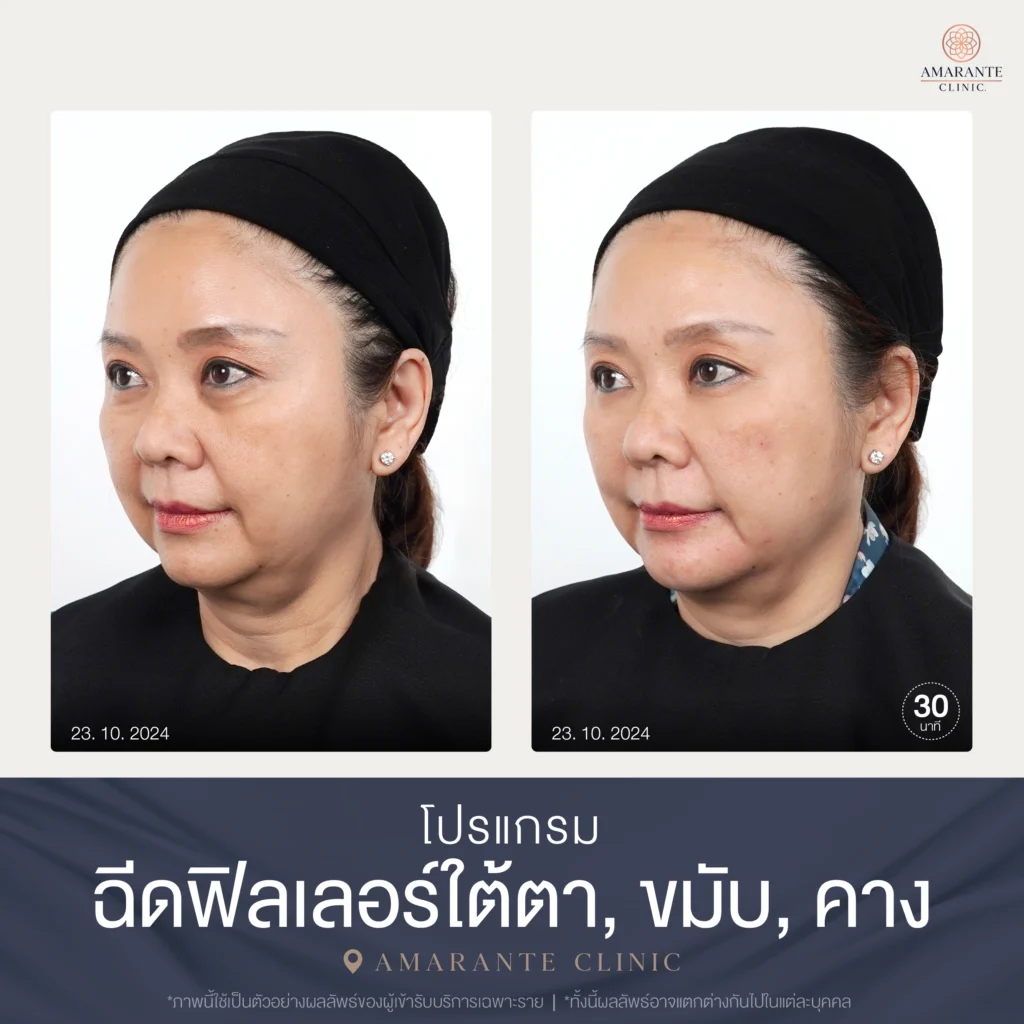 ภาพเคสรีวิวฉีดฟิลเลอร์ใต้ตา ขมับ คาง 10-2024