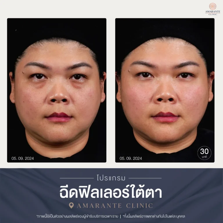 BA ฟิลเลอร์ใต้ตา-04-01