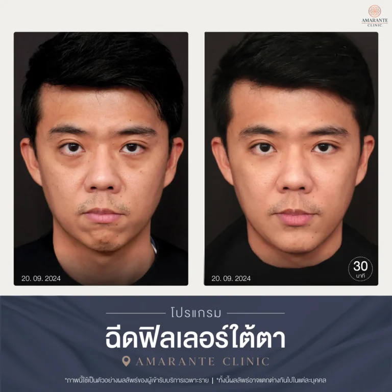 BA ฟิลเลอร์ใต้ตา-04-02