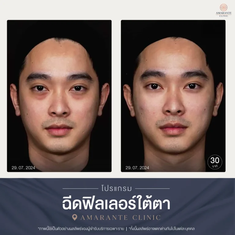 BA ฟิลเลอร์ใต้ตา-04-03