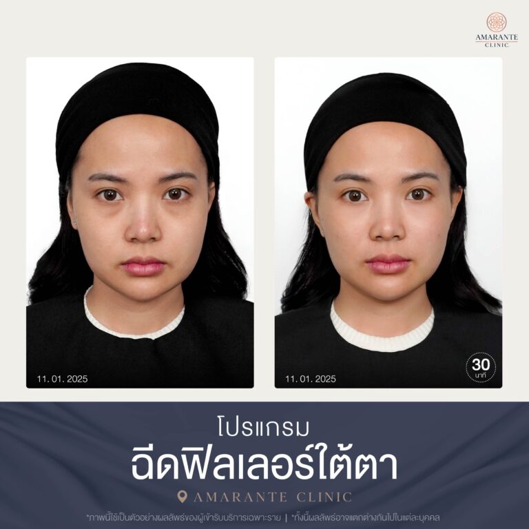 Before and After เคสฉีดฟิลเลอร์ใต้ตา 01-2025