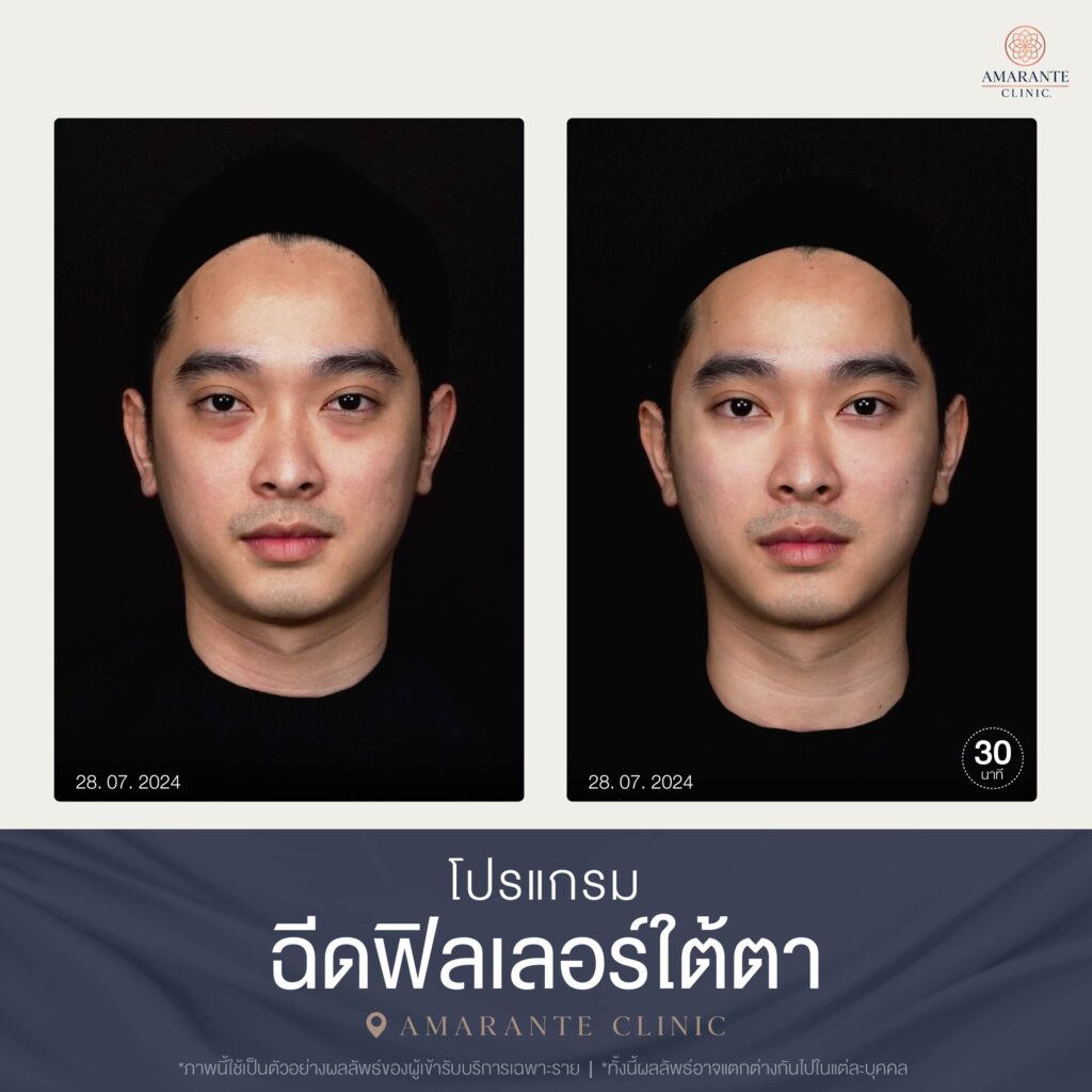 Before and After เคสฉีดฟิลเลอร์ใต้ตา 07-2024