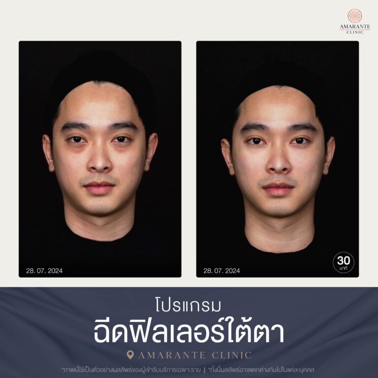 Before and After เคสฉีดฟิลเลอร์ใต้ตา 07-2024