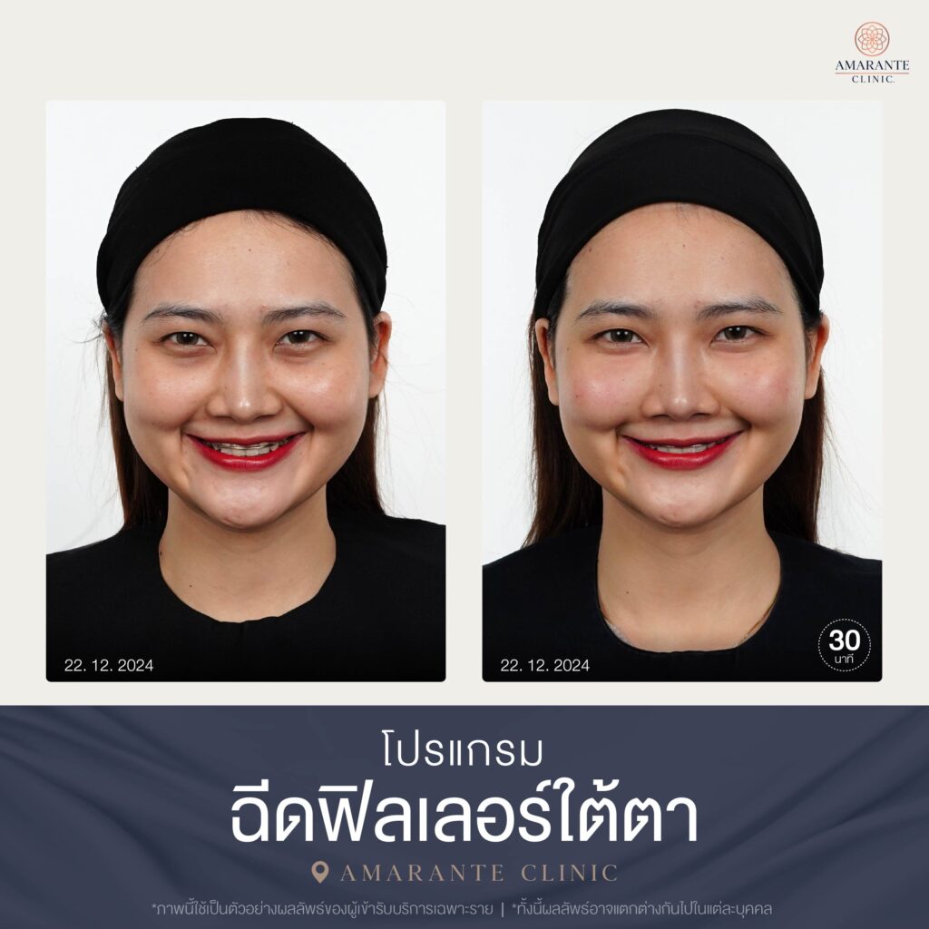 Before and After เคสฉีดฟิลเลอร์ใต้ตา 12-2024