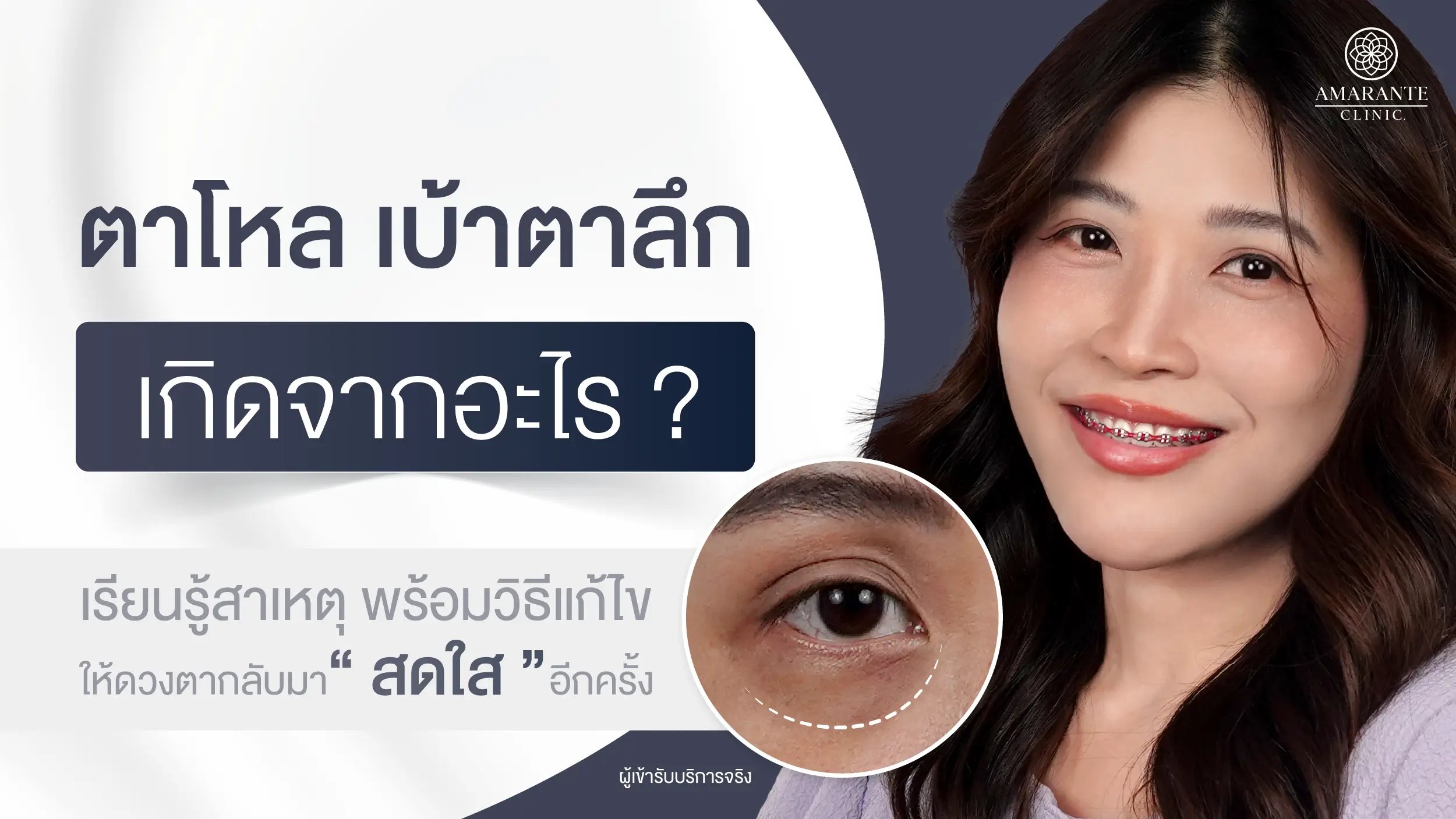 ตาโหล เบ้าตาลึก เกิดจากอะไรพร้อมวิธีแก้ไข