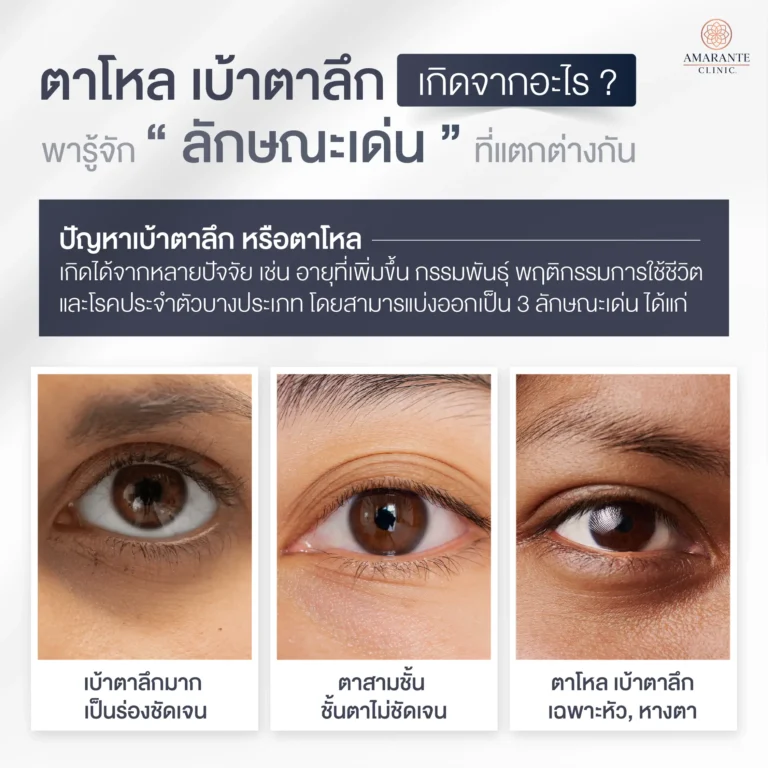 ตาโหล เบ้าตาลึก เกิดจากอะไร มีลักษณะอย่างไร?