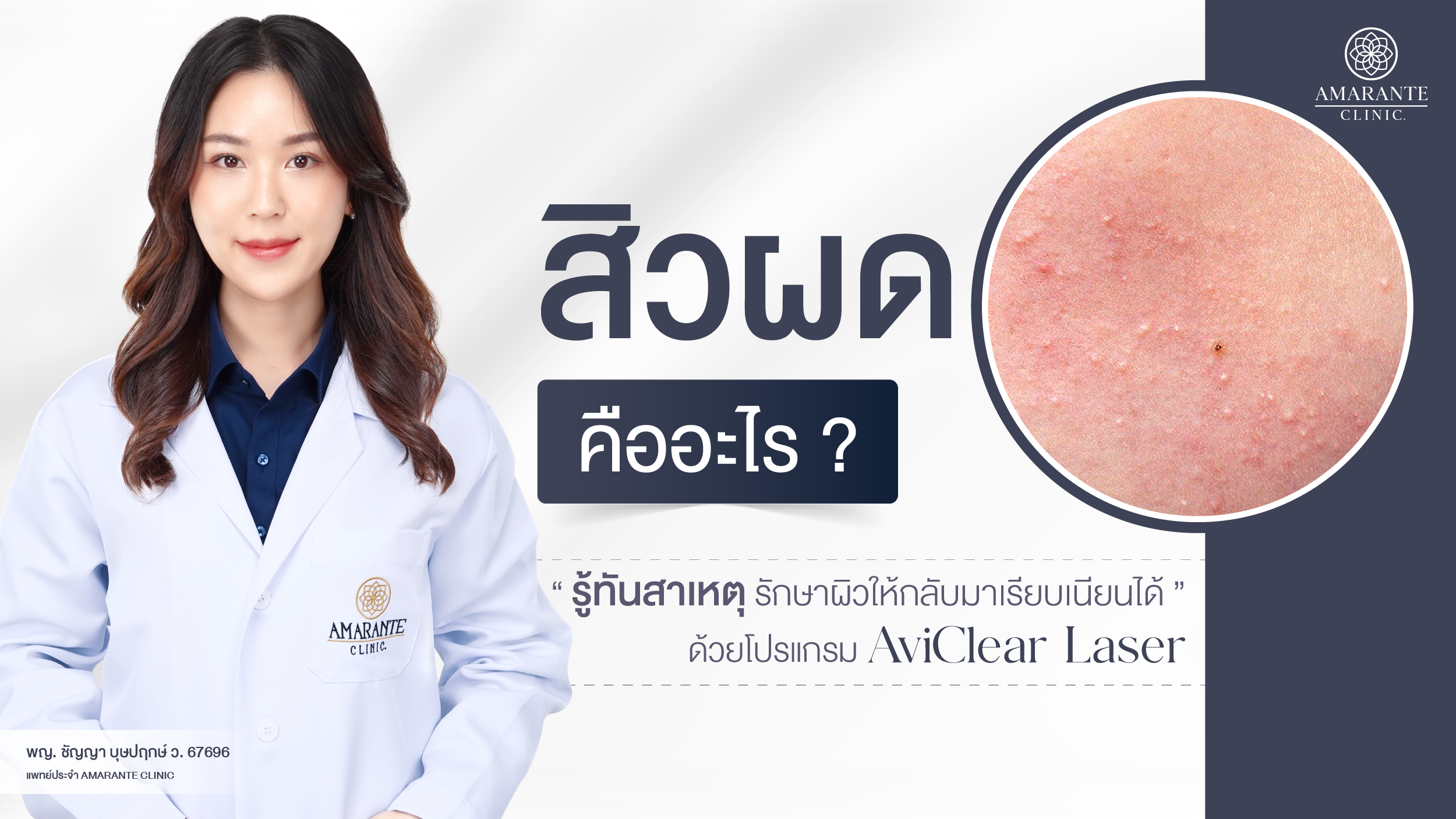 ปกภาพบทความ สิวผด คืออะไร สาเหตุเกิดจากอะไร และวิธีรักษาสิวผดให้ผิวเรียบเนียน