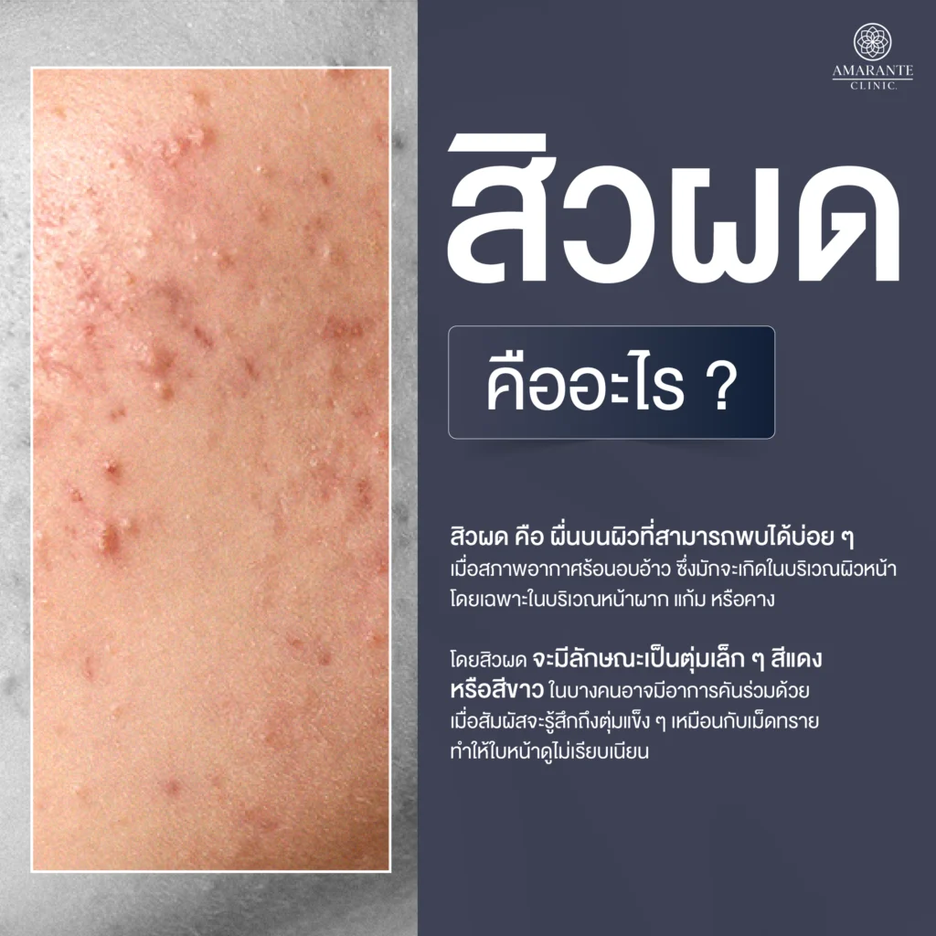 สิวผด คืออะไร?
