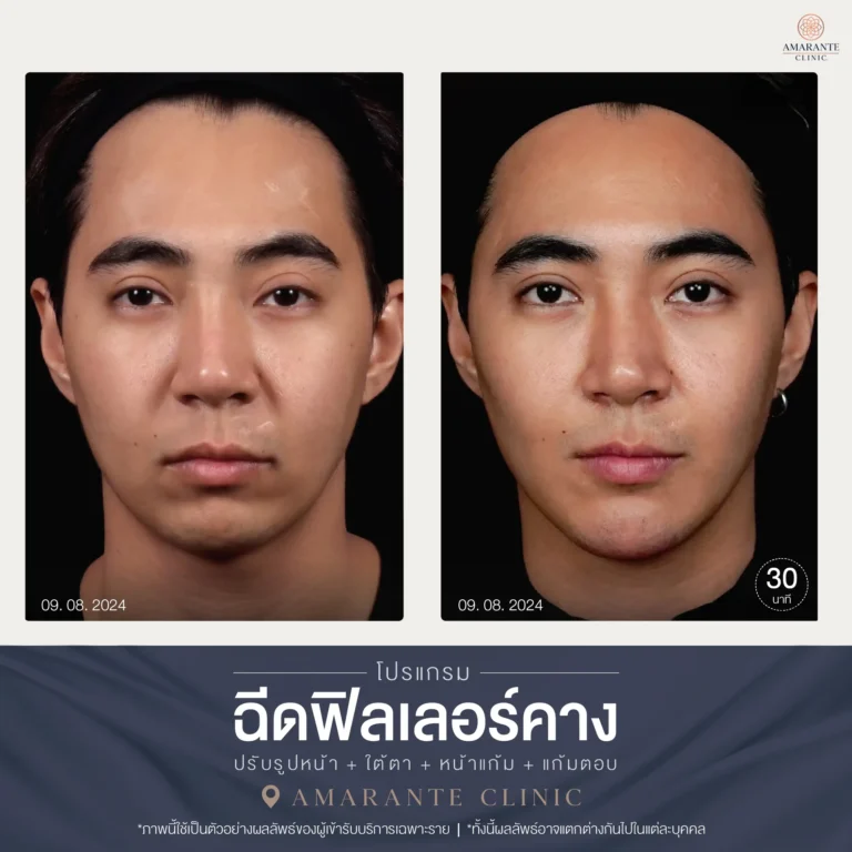 09-08-2024 รีวิวฉีดฟิลเลอร์คาง ภาพ Before and After หน้าตรง
