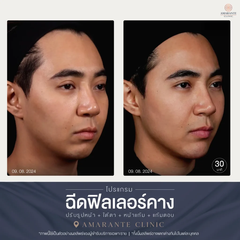 09-08-2024 รีวิวฉีดฟิลเลอร์คาง ภาพ Before and After หน้าหันขวา