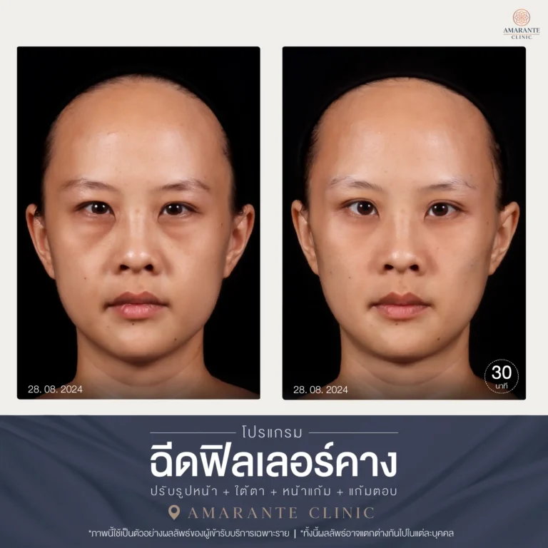 28-08-2024 รีวิวฉีดฟิลเลอร์คาง ภาพ Before and After หน้าตรง