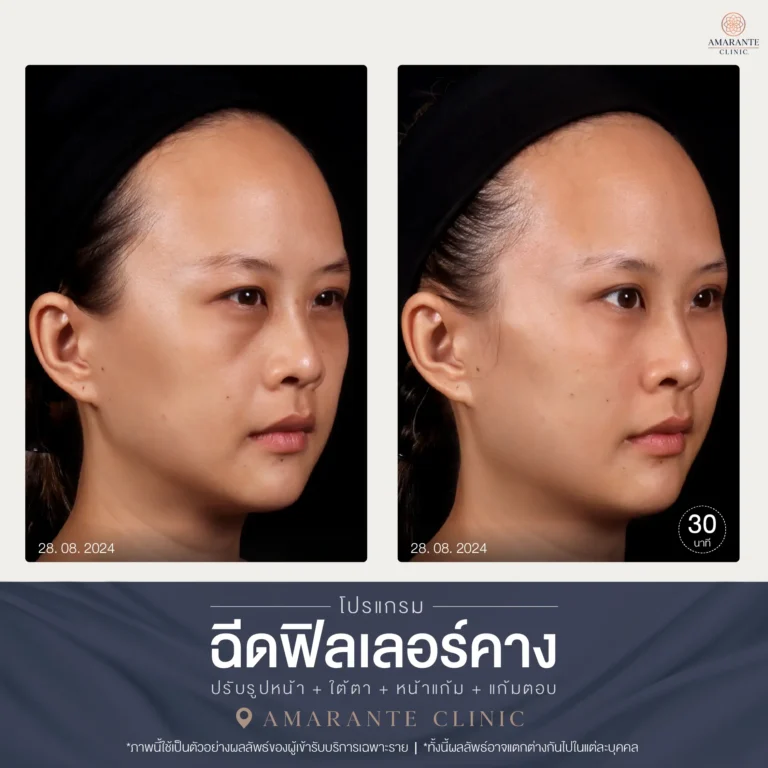 28-08-2024 รีวิวฉีดฟิลเลอร์คาง ภาพ Before and After หน้าหันขวา