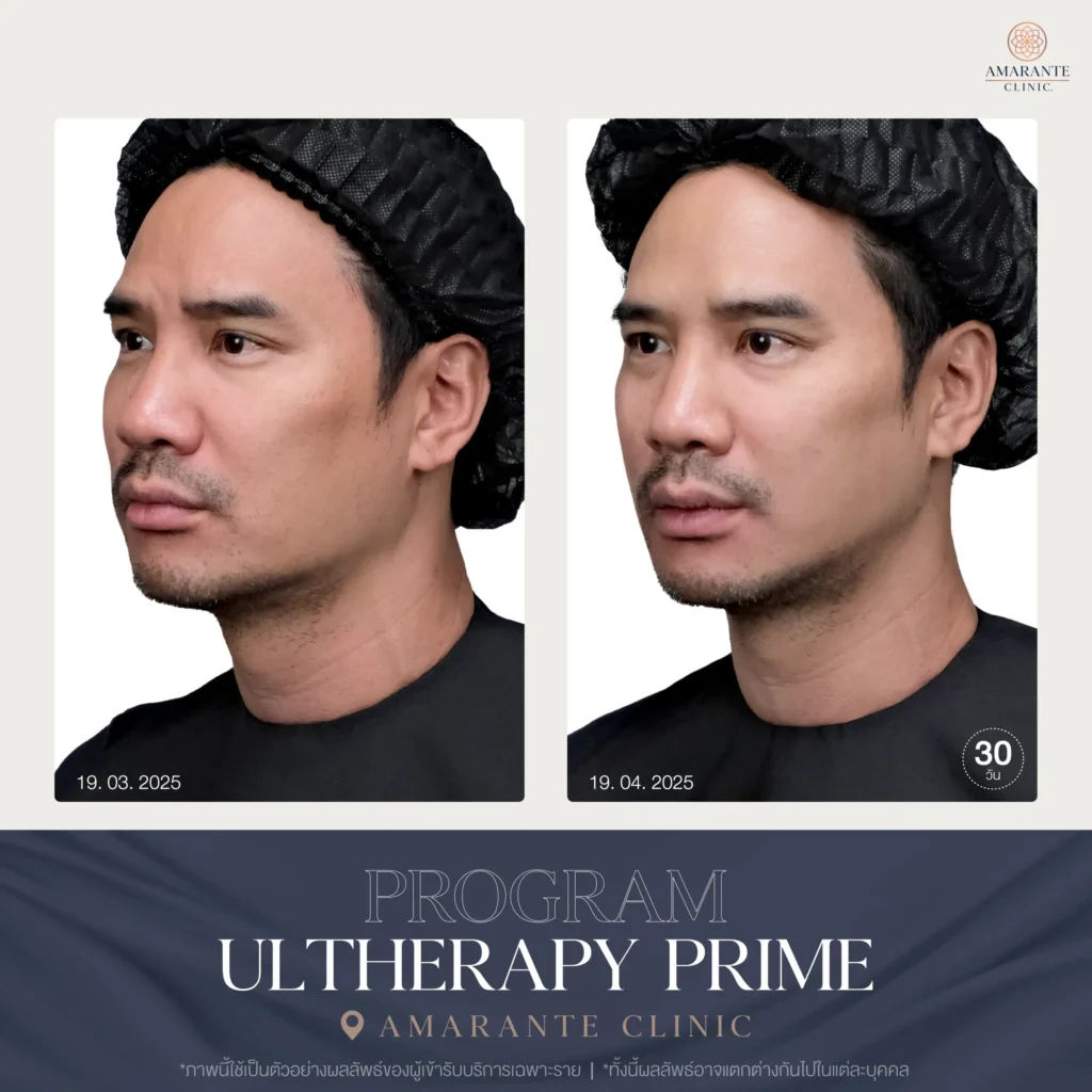 ภาพ Before and After Ulthera Prime คุณน็อต