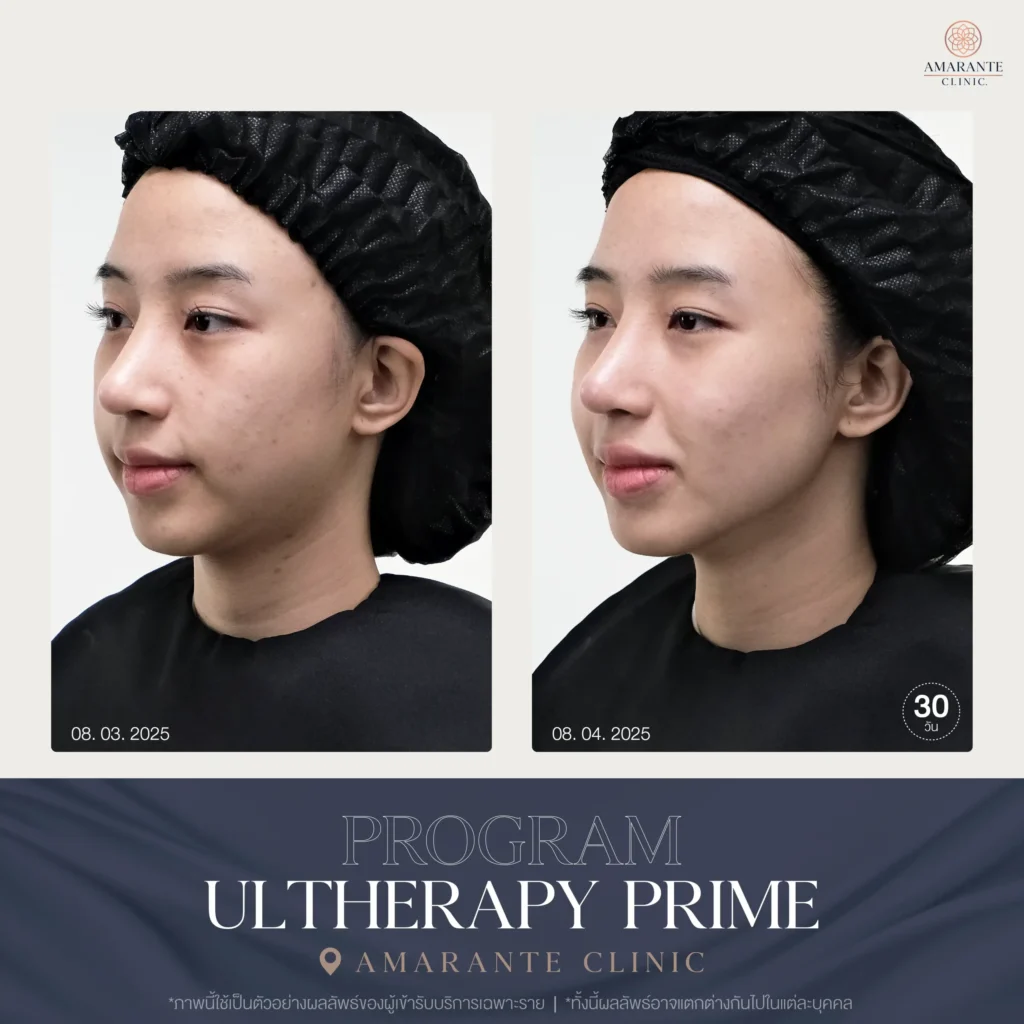 ภาพ Before and After Ulthera Prime 02
