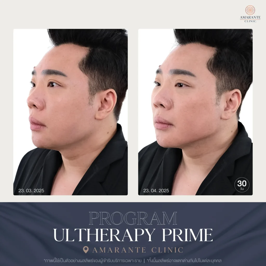ภาพ Before and After Ulthera Prime คุณมดดำ