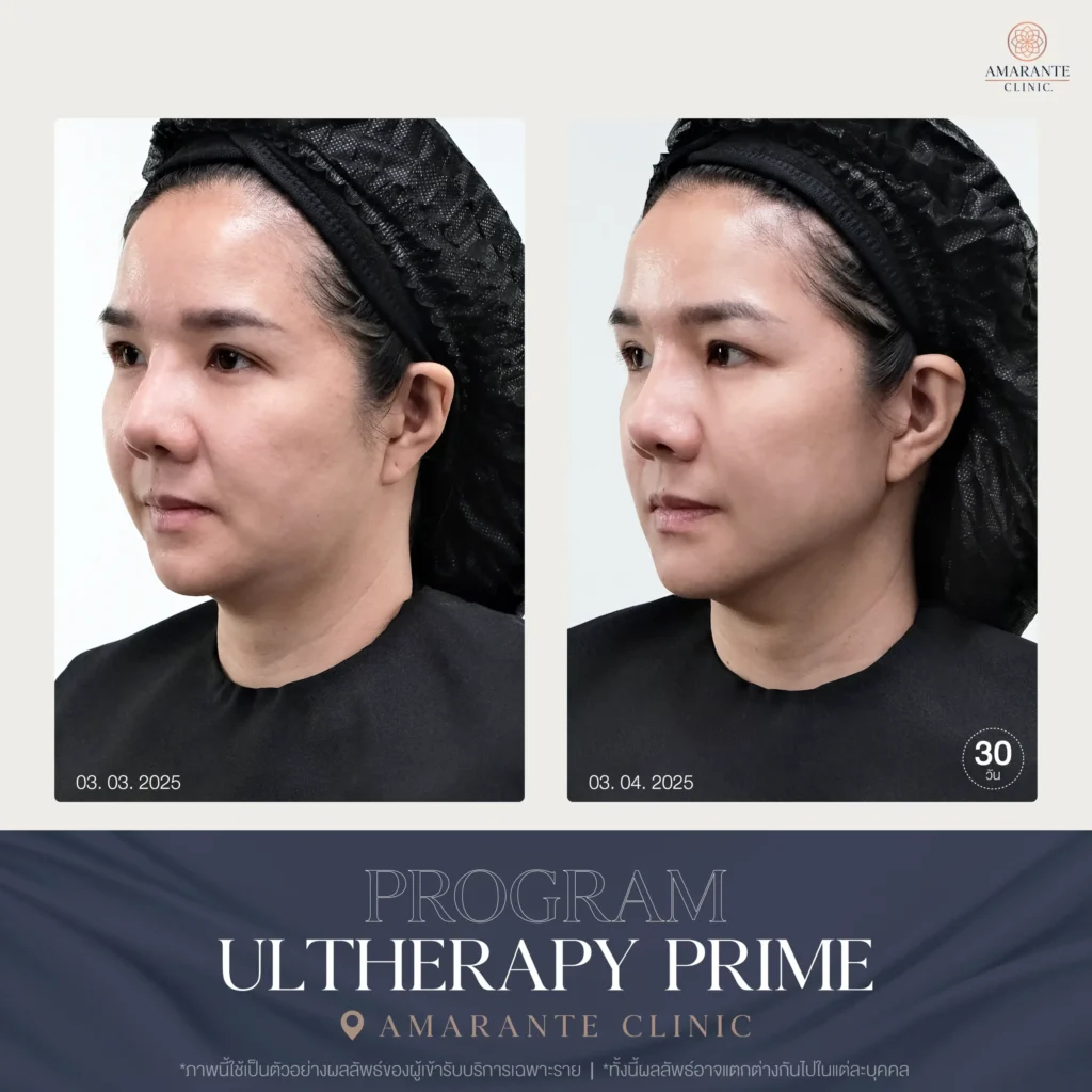 ภาพ Before and After Ulthera Prime 06