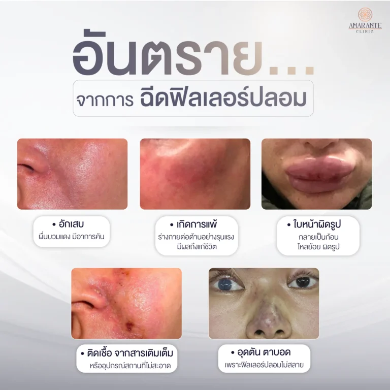 อันตรายจากการฉีดฟิลเลอร์ปลอม