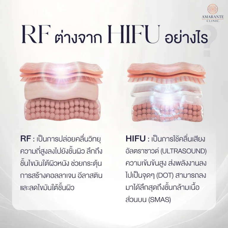 RF ต่างจาก hifu อย่างไร