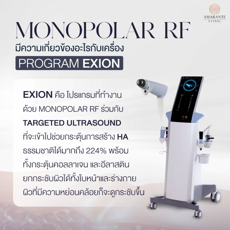 Monopolar RF มีความเกี่ยวข้องอะไรกับเครื่อง Exion