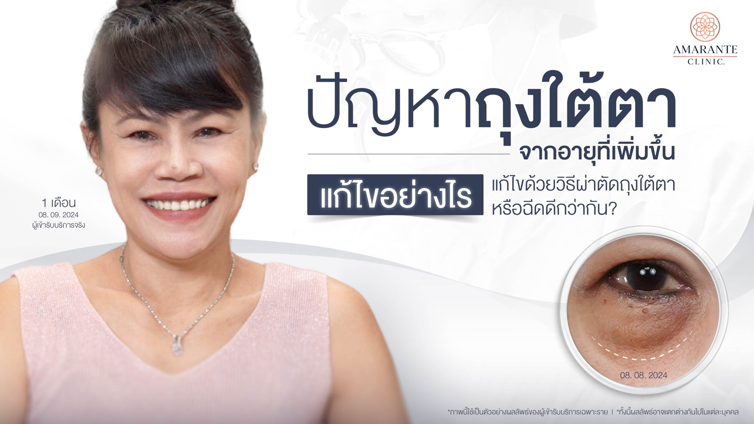 ปัญหาถุงใต้ตาจากอายุที่เพิ่มขึ้น แก้ไขด้วยการผ่าตัดหรือฉีดดีกว่ากัน