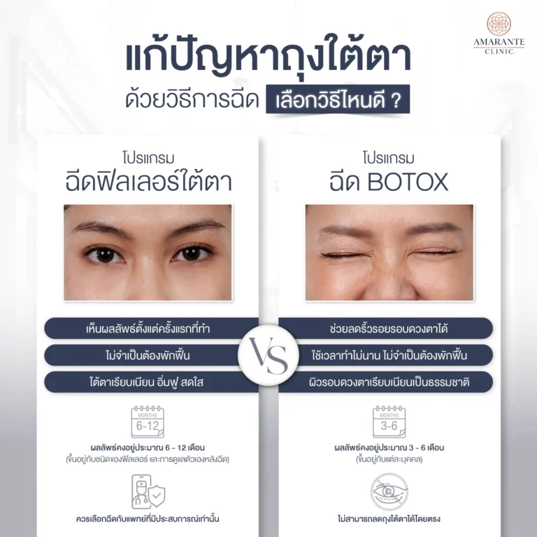 การแก้ปัญหาถุงใต้ตา ด้วยวิธีการฉีด