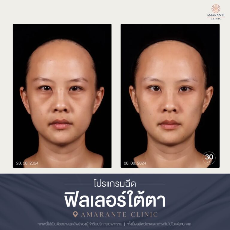 (บทความ) พบปัญหาถุงใต้ตาจากอายุที่เพิ่มขึ้น แก้ไขด้วยการผ่าตักหรือฉีดดีกว่ากัน-09
