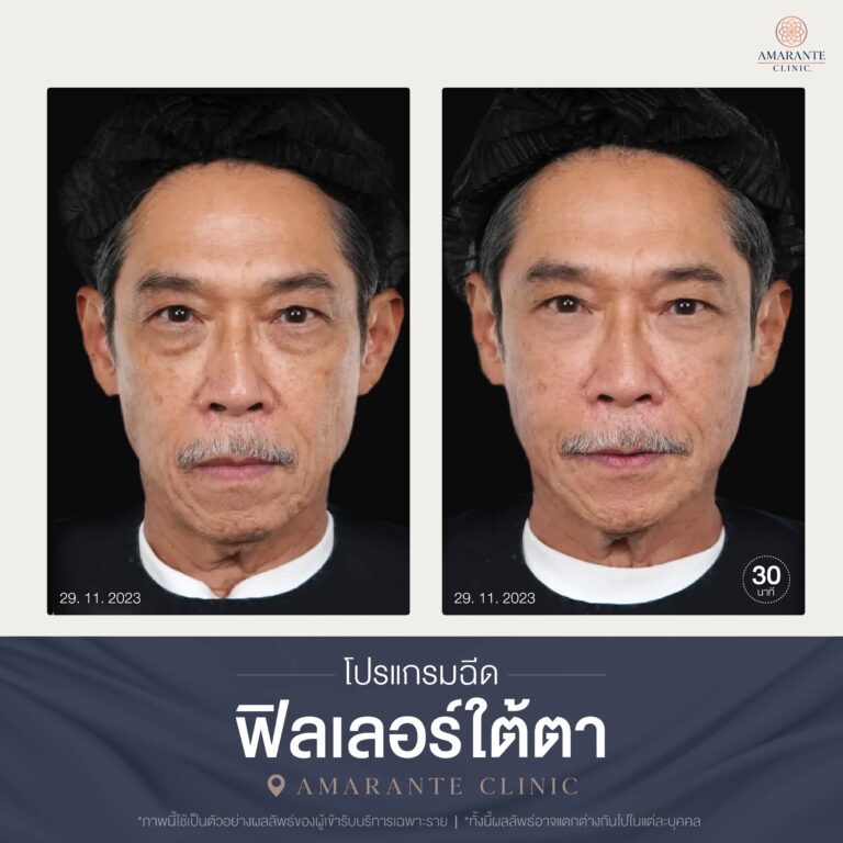 (บทความ) พบปัญหาถุงใต้ตาจากอายุที่เพิ่มขึ้น แก้ไขด้วยการผ่าตักหรือฉีดดีกว่ากัน-10