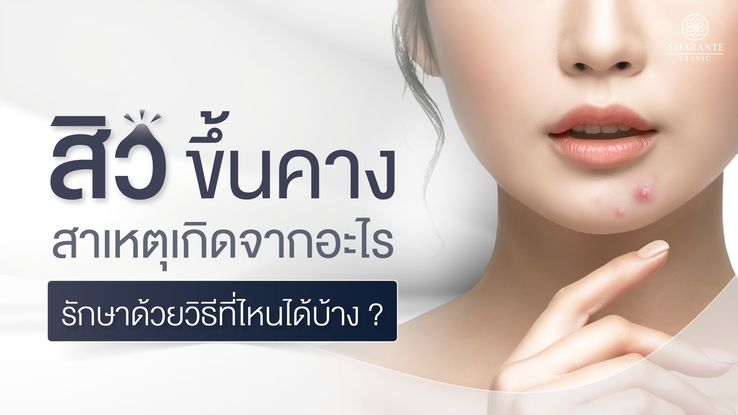 สิวขึ้นที่คาง สาเหตุเกิดจากอะไร รักษาด้วยวิธีที่ไหนได้บ้าง