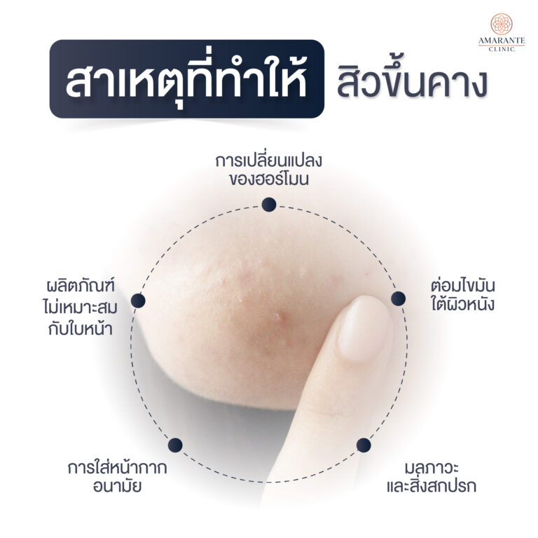 สาเหตุที่ทำให้สิวขึ้นที่คางเกิดจากอะไร?